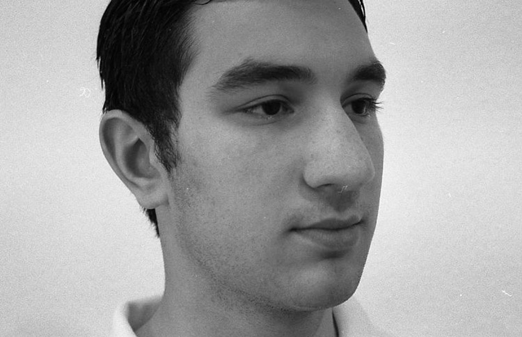 Unf&ouml;rmig breite Nase. Vor der Operation. 